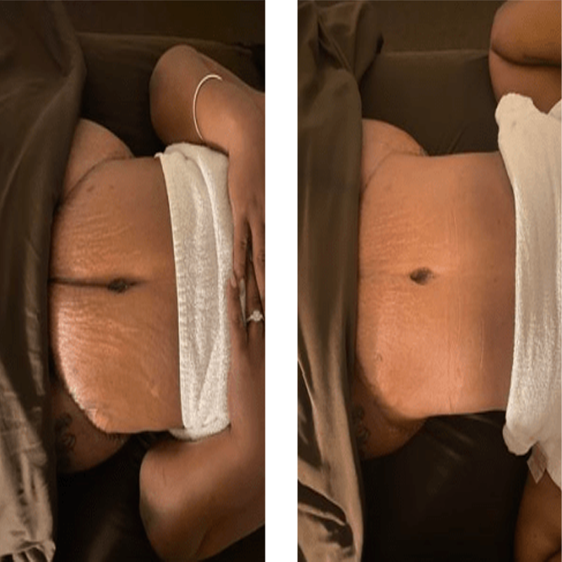 60 Lymphatic Drainage Massage